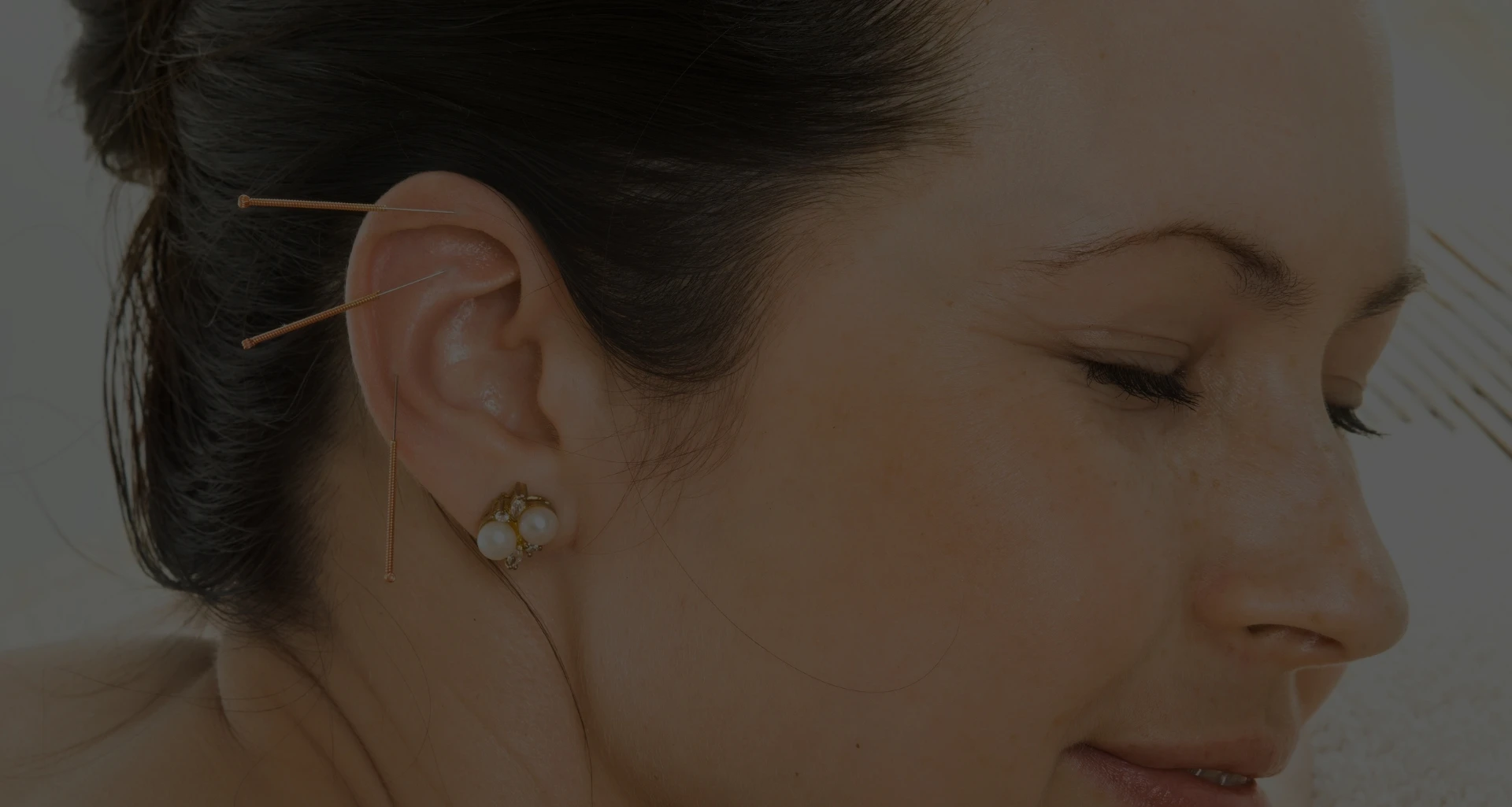 acupuncture suggestion points